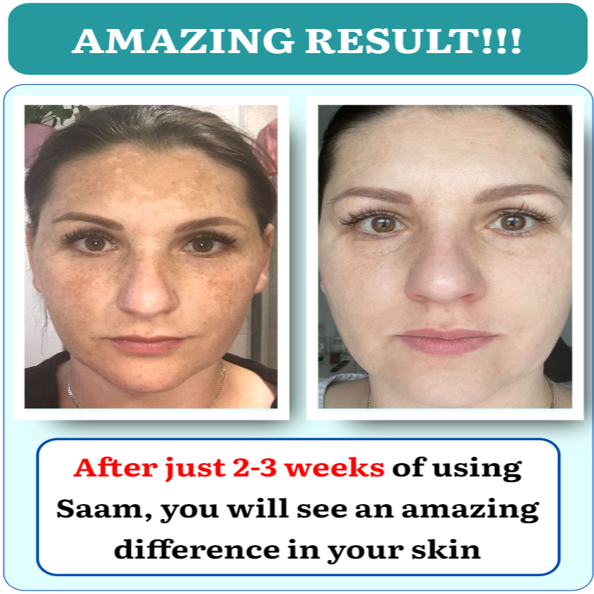 🔥LAST DAY 70% OFF🔥Saam Renewal Face Cream Treat Melasma, Freckles, Age Spots, Brighten Skin