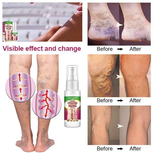 Vein Healing Varicose Veins Treatment Spray 50ml